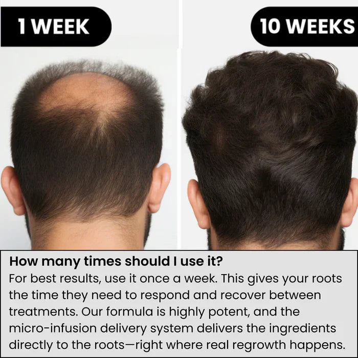 AlphaInfuse™ Hair Regrowth System