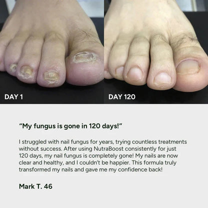 Nail Fungus Treatment Gel